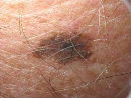 A melanoma mole will have different shades of the same color, such as brown or black or splotches of different colors (e.g., white, red, gray, black, or blue). The Spread Of Melanoma Metastasis