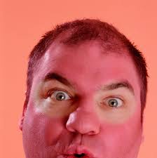 Why are Brits always so unpleasantly surprised after a day in the sun at  South Steyne beach in 40+ degree weather????????