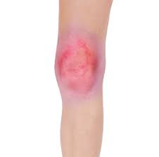 Image result for Septic Joint