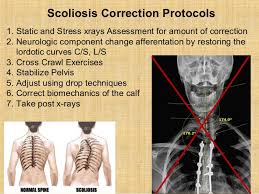 Sports to play if you have why scoliosis exercises are good for you? Scoliosis Correction