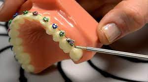 It provides fantastic temporary relief from most braces hiccups. Wax A Great Temporary Fix For Braces With Poking Wire Youtube