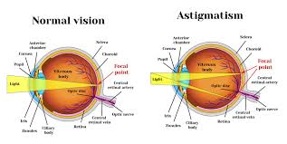 Astigmatism Is A Focal Disorder That Occurs Due To Changes In The Surface Of The Cornea Or Lens Which Causes Blurri Eye Exercises Astigmatism Vision Disorders