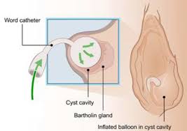 Image result for Bartholin's gland abscess