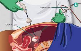 Tajzoy, md, pllc, diagnoses ovarian cysts, he also tells you what type of cyst you have. Ovarian Cyst Removal Cystectomy Surgery Procedure Purpose Results Cost Price