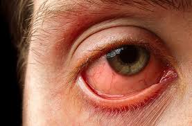 Image result for Gonococcal Conjunctivitis