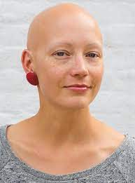 Author Helen Phillips On Living With Alopecia Refinery29uk Bald Women Bald Girl Shaved Head Women
