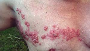 Herpes is one of the most common sexually transmitted diseases which can affect multiple organ systems including the lips and. Herpes May Lay Dormant For Years