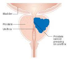 Prostate cancer is one of the most common types of cancer diagnosed in men. Prostate Cancer Wikipedia