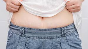 Stretch mark bisa juga disebabkan oleh kenaikan berat badan. 5 Cara Menghilangkan Stretch Mark Yang Membandel Lifestyle Liputan6 Com
