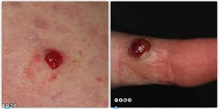 There are also many other reasons for having cherry angiomas, including iodine deficiency, the genetic factor of family history of growing cherry angiomas, hormonal changes during pregnancy, liver disorders or liver transplants, exposure to the sunlight, polluted environment, etc. Mimics Of Skin Cancer Ii Skin Cancer 909