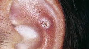 Chondrodermatitis Nodularis Helicis Symptoms And More