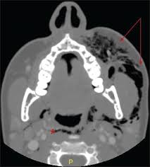 Necrotizing meningoencephalitis is the scientific name for a disease that causes two crucial health issues. The Case Files A Deflected Blow A Mimic Of Necrotizing Fasciitis