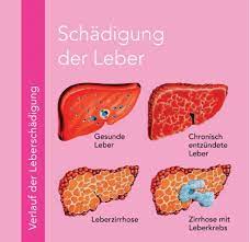 Nov 24, 2020 · hepatitis is inflammation of the liver. Isarpraxis