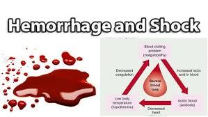 Image result for Hemorrhage Classification