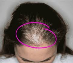 It's an unwelcome occurrence, and in many cases it can leave women feeling blindsided and defeated. Http Creciones Artesana Blogspot Com 15 Causes Of Women S Hair Loss And How To Treat It