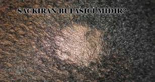 Sackiran Bulasici Midir Buz Terapisi Http Www Ciltshop Com Sackiran Bulasici Midir Buz Terapisi