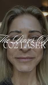 Ever wonder what recovery really looks like after CO2 laser resurfacing? ,   Watch to follow our lovely patient Toni’s day-by-day journey!✨, Toni’s main  concern was the texture under her eyes, and she ...