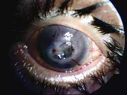 Why you should recommend blink? How Many Times A Day Does The Average Person Blink Quora