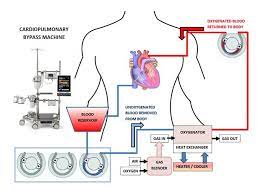 The circuit starts at the right heart side, where all/part of the venous return is drawn into the reservoir via a venous cannula(s). Cardiopulmonary Bypass Machine Cpb