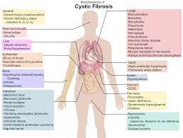 Ochorenie je spôsobené poruchou prenosu iontov a solí. Cystic Fibrosis Writework