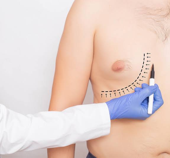 Gynecomastia Surgery | Male Chest Contouring CMC Dubai