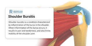 Image result for Bursitis