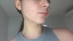 What skin care products are good for adult mild acne. I don't wear make up  everyday. I have to attend wedding after 2 weeks so want it gone. Tia