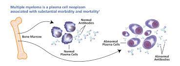 Multiple myeloma is a type of cancer that affects plasma cells. Multiple Myeloma