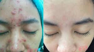 Tips hilangkan komedo hidung dengan cepat.mp4 download. Cara Menghilangkan Jerawat Parut Jerawat Tips Doktor Pakar Motif My