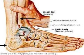 A grade ii ankle sprain is more severe partial tearing of the ligament. Ankle Sprains Grade 1 Stretching With Minor Tearing Grade 2 Partial Tear Grade 3 Full Rupture Type 2 And 3 Might Ha Sprained Ankle Sprain Ankle Anatomy