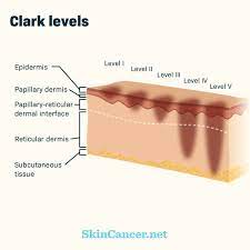 Skin cancer is the most common type of cancer in the united states by a pretty large margin, and it does not discriminate. Stages Of Melanoma Skincancer Net