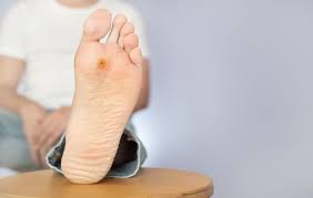 This being the case i will not include any visual aides (also my pictures. Warts Fairfield Podiatry