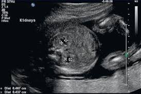 Trisomy 13 and 18 are very different in terms of what you can see on ultrasound. Trisomy 13 Radiology Key