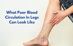 What Causes Poor Blood Circulation In Legs? | USA Vein Clinics