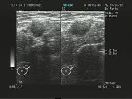 Radioterapia modernă este una dintre. Https Www Hilarispublisher Com Open Access Particularities Of Primary Breast Cancer In Men 1584 9341 12 1 8 Pdf