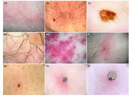 Image result for Trombicula autumnalis bites