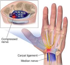 Kejadian pergelangan tangan sakit akibat carpal tunnel syndrome berhubungan dengan gerakan berulang, seperti mengetik, mencuci dengan tangan, mengulek, dan sebagainya. Pergelangan Tangan Sakit Ini Penyebab Dan Terapinya Honestdocs