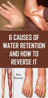Identifying Estrogen Dominance In The Body And Treating It In 2020 Water Retention Water Retention Remedies Health