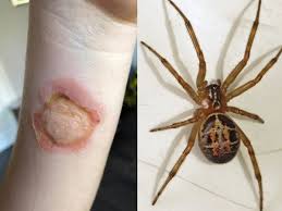 The bite of a black widow spider is dangerous because it can affect a person's nervous system. Mum S Horror After Spider Bite Makes Daughter S Skin Look Like It S Being Eaten Essex Live
