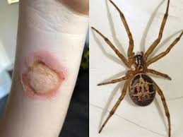 I was a bit blasé, i'm a man's man, i don't like going to the doctor for nothing and i certainly wasn't going to hospital for an insect bite. Mum S Horror After Spider Bite Makes Daughter S Skin Look Like It S Being Eaten Essex Live