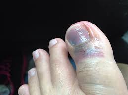 Cara mengurut kaki anda 15 langkah dengan gambar tips 2021. Ambrynaa S Photo Diary Kemalangan Dalam Rumah Tulang Ibu Jari Retak