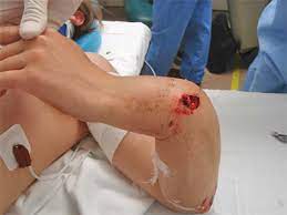 Fracture Types And Mechanisms Of Injury Wikiradiography