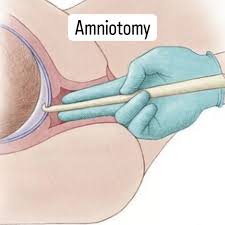 Image result for Amniotomy