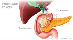 Sometimes, pancreatic cancer may damage the cells in your pancreas that help produce insulin (the hormone that regulates your blood sugar, which is made in the pancreas), leading to high blood sugar and diabetes. Signs Of Pancreatic Cancer 12th Most Common Cancer In United States