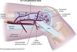 On the posterior surface of the condyle the linea aspera turns into the medial and lateral supracondylar ridges, respectively. The Limits Of Medial Femoral Condyle Corticoperiosteal Flaps Journal Of Hand Surgery