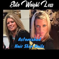 Biotin Pills Hair Growth Results Before And After Pin On Elite Edge Weight Loss Wonders