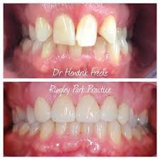 When You Have Crooked Teeth And A Few Missing Use Invisalign Straumann Implants And Emax Porcelain To Create A Beautiful Smile Agai Dentes Coisas Para Comprar