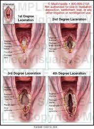 Maybe you would like to learn more about one of these? Kemaluan Wanita Selepas Bersalin Lolishie