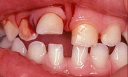 Image result for Tooth Luxation