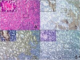 Necrotic cells appear pink on h&e staining. P16 Ink4a Expression In Retinoblastoma A Marker Of Differentiation Grade Diagnostic Pathology Full Text